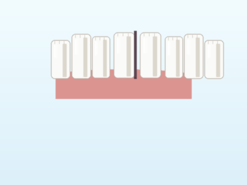 Gaps Between Teeth